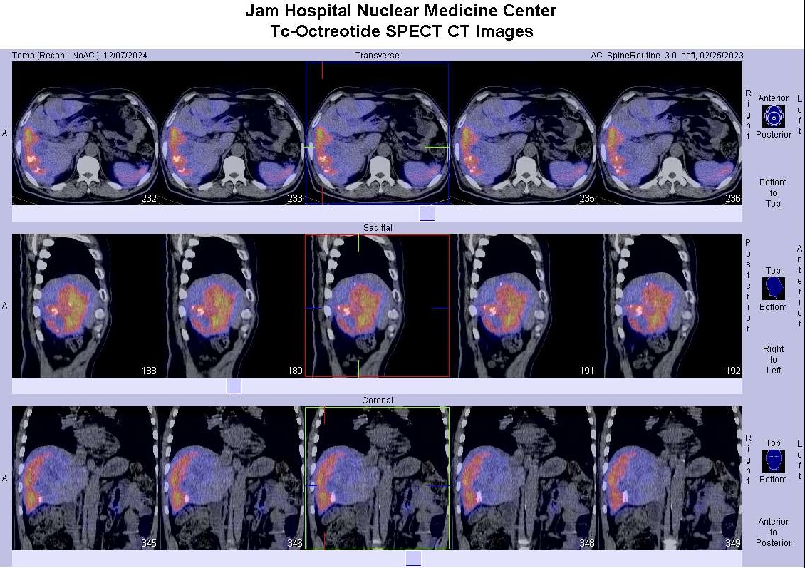 اوكتروتايد SPECT-CT